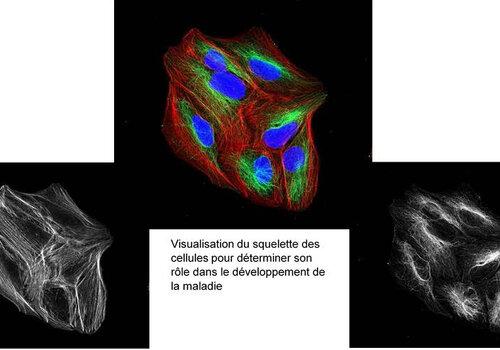 Une maladie génétique : la neurofibromatose – Comprendre pour guérir